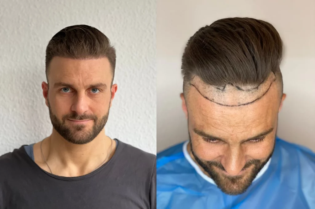 Till vor und nach der Haartransplantation in Köln