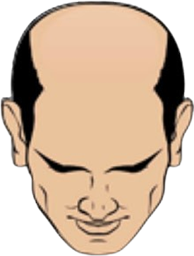 Haartransplantation Halbglatze oder Glatze