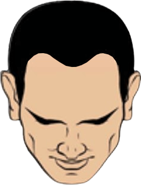 Haartransplantation Halbglatze oder Glatze